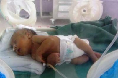 المؤتمر نت - وفاة رضيع يمني متاثرا بقصف العدوان السعودي لمحيط مستشفى السبعين - صنعاء - المؤتمرنت